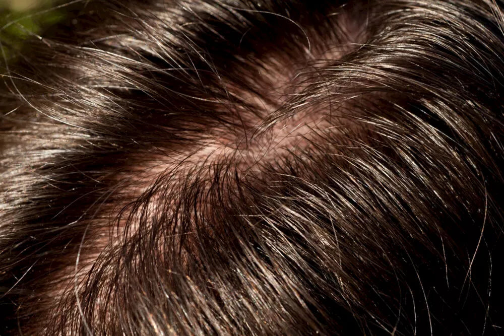 Fettige Kopfhaut & Haar
